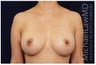 Breast Augmentation