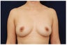 Breast Augmentation