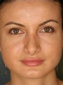 Caucasian Revision Rhinoplasty