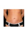 Mini Tummy Tuck on Female Patient