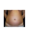 Mini Tummy Tuck on Female Patient