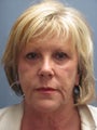 Blue Peel®, Liposuction, LiteLift™ on 61-year-old Woman