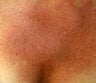 cleavage rejuvenation