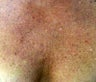 cleavage rejuvenation