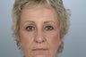 58 year old Female treated for droopy eyelids