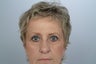 58 year old Female treated for droopy eyelids