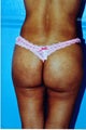 brazilian butt lift in a thin patient