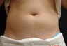 Coolsculpting Abdomen