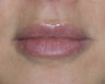 Lip Injections