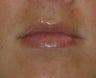 Lip Injections