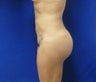 Brazilian Butt Lift