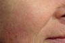 Laser Genesis