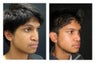 Rhinoplasty