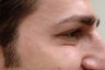 Botox