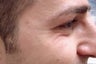 Botox