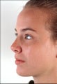 Rhinoplasty