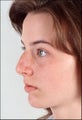 Rhinoplasty