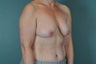 Breast Lift