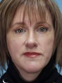 Lower Eyelid Hetter Peel