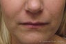 Juvederm®
