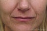 Juvederm®