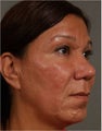 44 year old hispanic patient requesting a stronger chin and more defined nasal tip