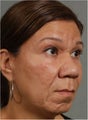 44 year old hispanic patient requesting a stronger chin and more defined nasal tip