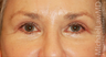 Eye Bag Surgery