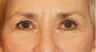 Eye Bag Surgery