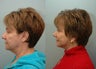 Facial Reconstructive Surgery