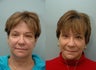 Facial Reconstructive Surgery