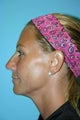 46 Year Old Female treated for neck laxity with Ultherapy