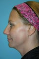 46 Year Old Female treated for neck laxity with Ultherapy