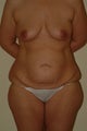 Lower body lift and breast lift