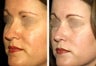 Female Revision Rhinoplasty
