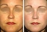 Female Revision Rhinoplasty