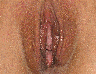 Vaginoplasty