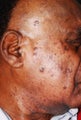 Skin Rejuvenation for Male Patient