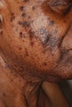 Skin Rejuvenation for Male Patient