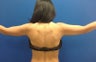 Laser airbrush liposuction of arms