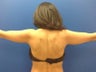 Laser airbrush liposuction of arms