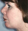 Neck Liposuction