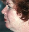 Neck Liposuction