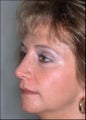 Revision rhinoplasty