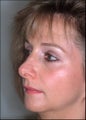Revision rhinoplasty