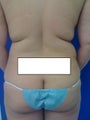 Laser Lipo