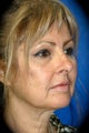 Laser Skin Resurfacing