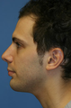 Chin/Neck Liposuction