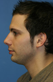 Chin/Neck Liposuction