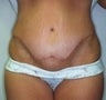 Female patient who underwent surgery for major weight loss